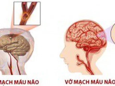 Điều trị tai biến mạch máu não