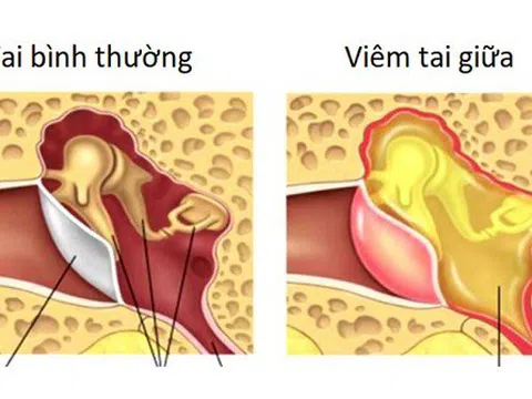 Lương y Bùi Văn Luận với bài thuốc Nam gia truyền chữa hiệu quả bệnh viêm tai